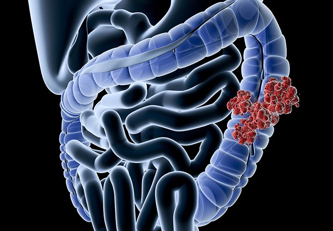 Foundational Research Yields Clues to Understanding Early-Onset Colorectal Cancer